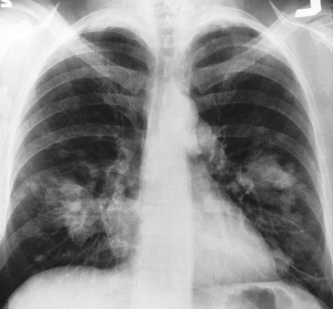 Radiographie du thorax montrant un cancer probable du poumon (taches claires)