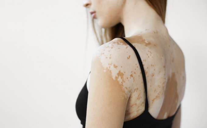 Quelles sont les causes du vitiligo ?