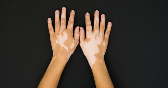 Vitiligo : existe-t-il des traitements ?