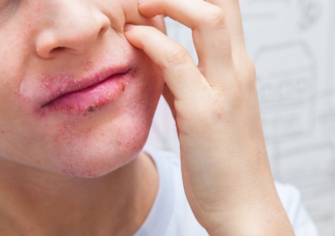 La dermatite séborrhéique : une maladie qui touche le visage 