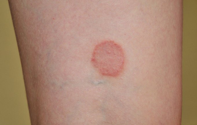 Plaques rouges sur les jambes et poignets : c&apos;est peut-être un lichen plan !