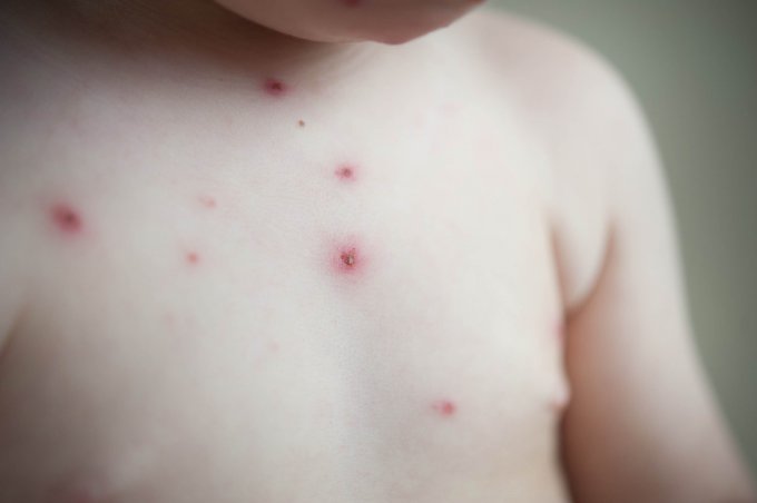 La varicelle, des rougeurs accompagnées de vésicules