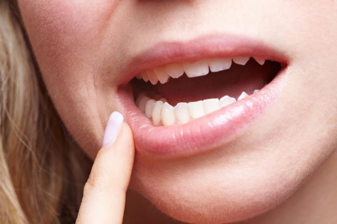 Le déchaussement dentaire, qu’est-ce que c’est ?