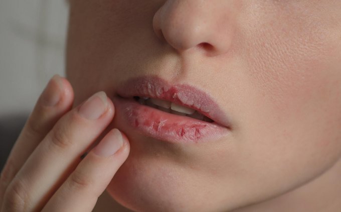 dermatillomania skin picking woman has bad habit to pick her lips harmful addiction based on anxiety stress and dry lips ...
