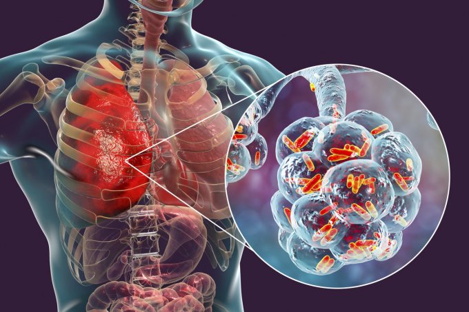 Comment le microbiote peut causer une infection pulmonaire ?