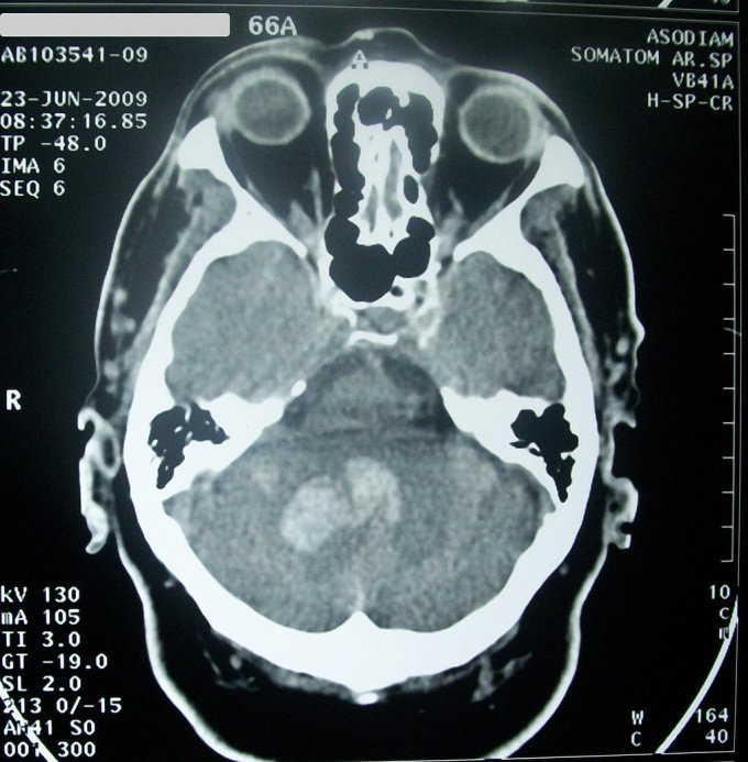Photo : scanner d&apos;une hémorragie intracérébrale 