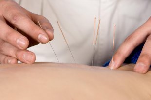 L&apos;acupuncture contre les douleurs chroniques