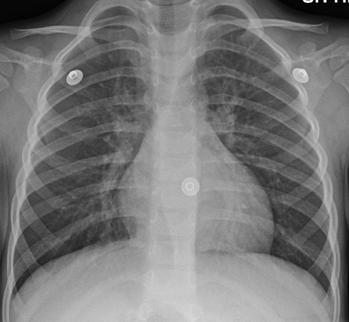 Photo de poumons touchés de bronchite virale