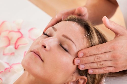 L’acupuncture, solution anti migraine