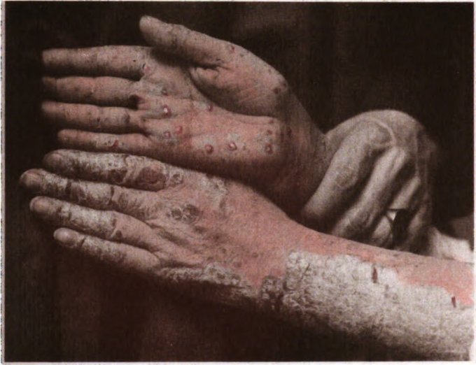 Photo du psoriasis pustuleux sur la paume des mains