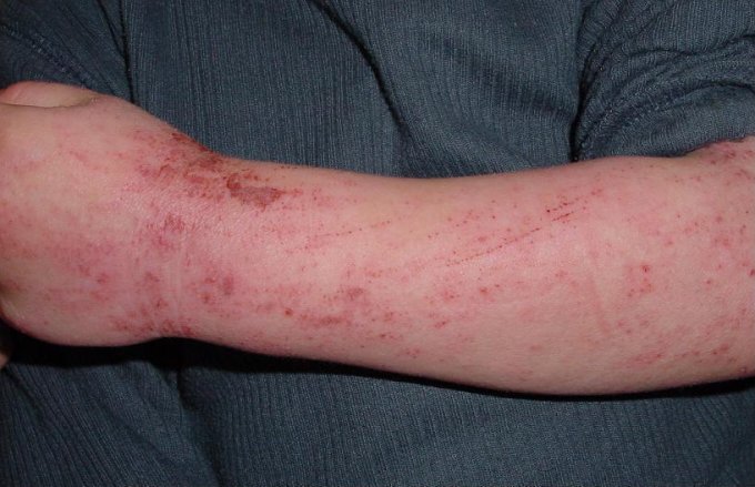 Quels sont les symptômes de la dermatite atopique ?