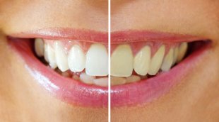 Dents jaunes : m&eacute;fiez-vous des dentifrices blanchissants !