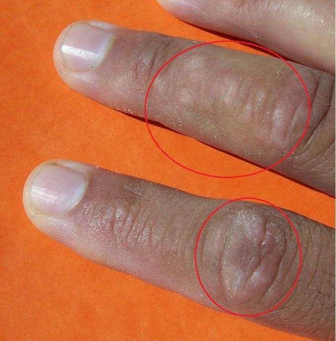 Photo de psoriasis pustuleux sur les doigts