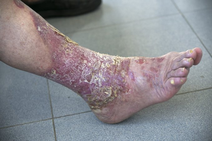 Photo : psoriasis au pied dans un état très grave