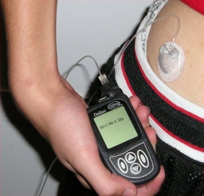 Diabète : la pompe à insuline utile pour les femmes enceintes ?