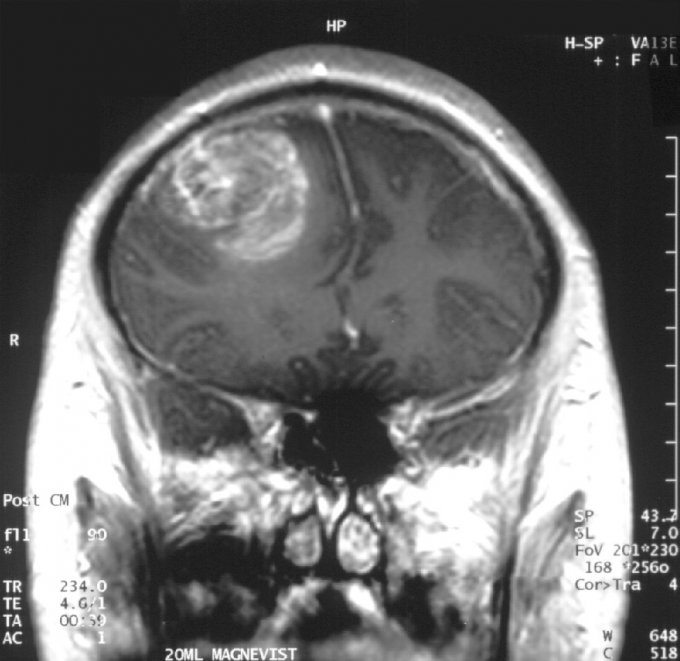 Image IRM d&apos;un glioblastome de grade IV