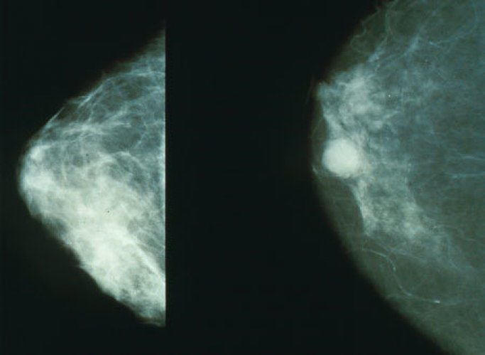 Photo : image de mammographie normale (gauche) versus cancéreuse (droite)