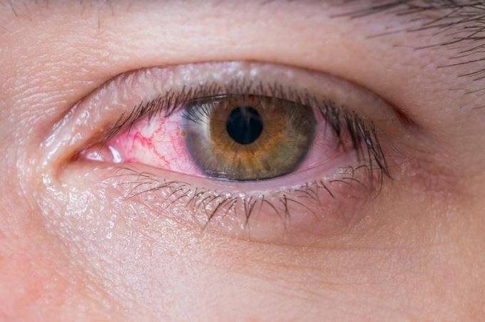 L’herpès oculaire ou ophtalmique