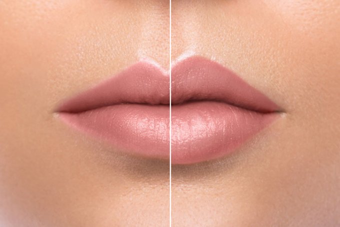 Les injections de Botox aux lèvres (avant/après)