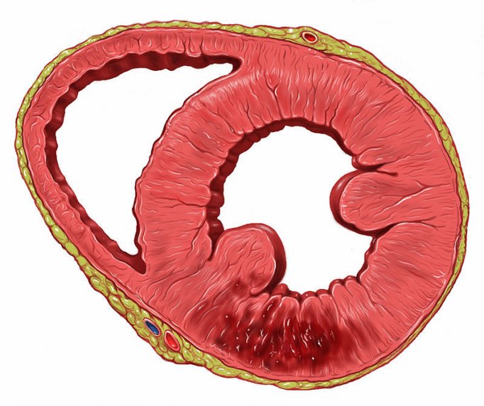 Photo : infarctus de la région inférieure du myocarde, en rouge sombre, la zone nécrosée de la paroi du muscle cardiaque