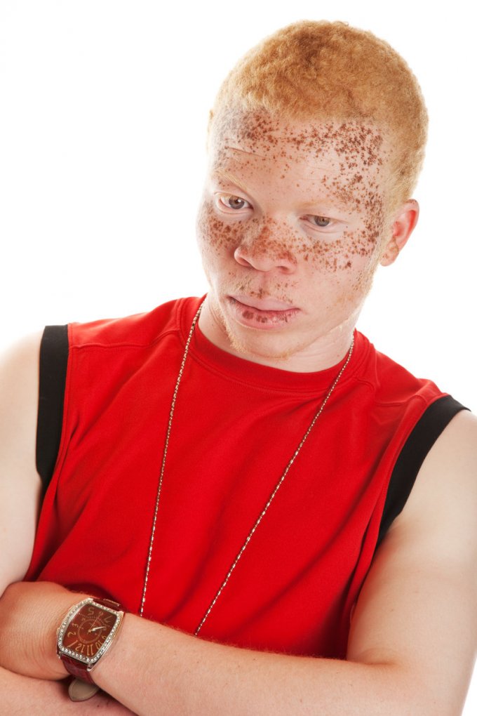 Quelle est la prévalence de l’albinisme ?               