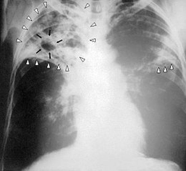 Le dépistage de la tuberculose active (symptomatique et contagieuse)