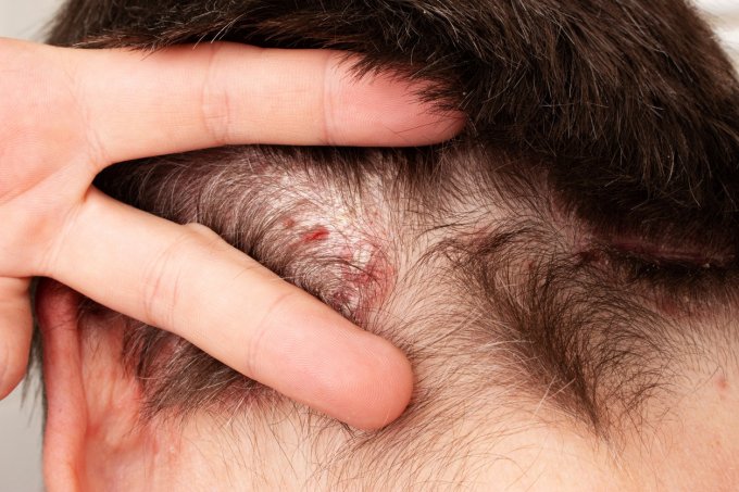 Psoriasis du cuir chevelu : symptômes, causes, traitements