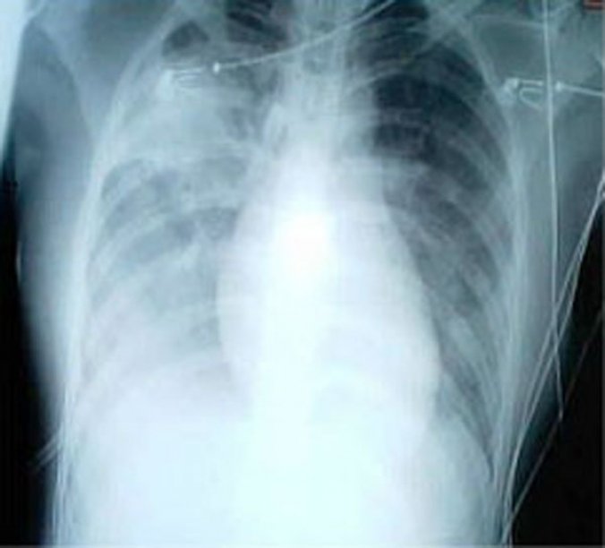 Photo : une radiographie pulmonaire montrant une opacité accrue des deux poumons, signe d&apos;une pneumonie, chez un patient atteint du SRAS