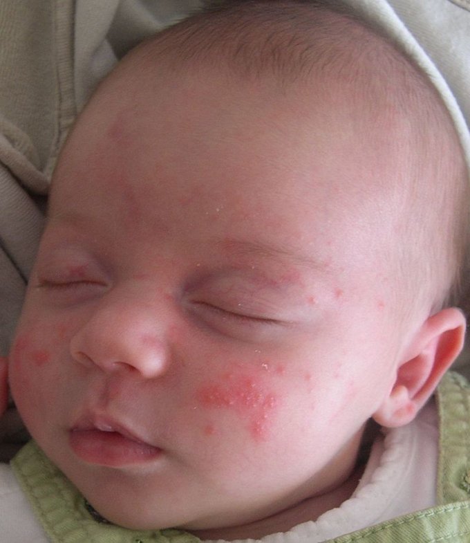 Quels sont les symptômes de l&apos;acné du nourrisson ? 