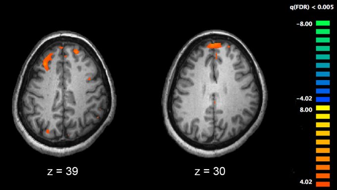 Photo : Zones cérébrales moins actives lors d&apos;une tâche de mémoire chez les patients schizophrènes (à droite) 