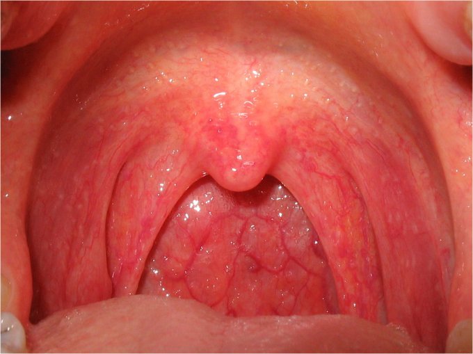 Allergie et mal de gorge : comment attrape-t-on une pharyngite ?