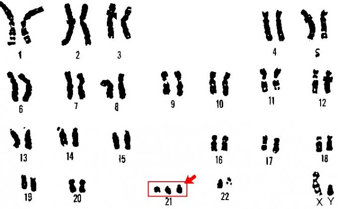 Illustration : caryotype (arrangement standard des chromosomes d&apos;une cellule) d&apos;un garçon trisomique.