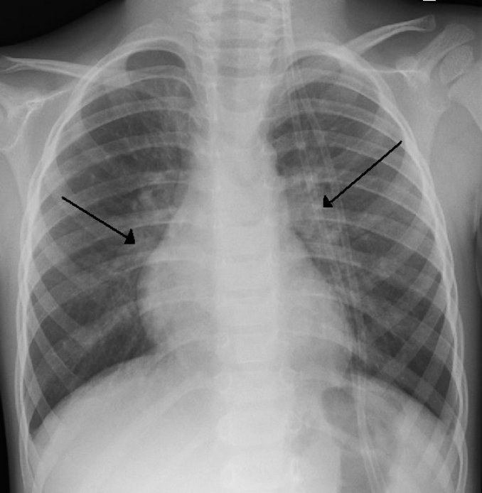 Photo : radiographie thoracique d&apos;un enfant montrant des opacités typiques de bronchiolite