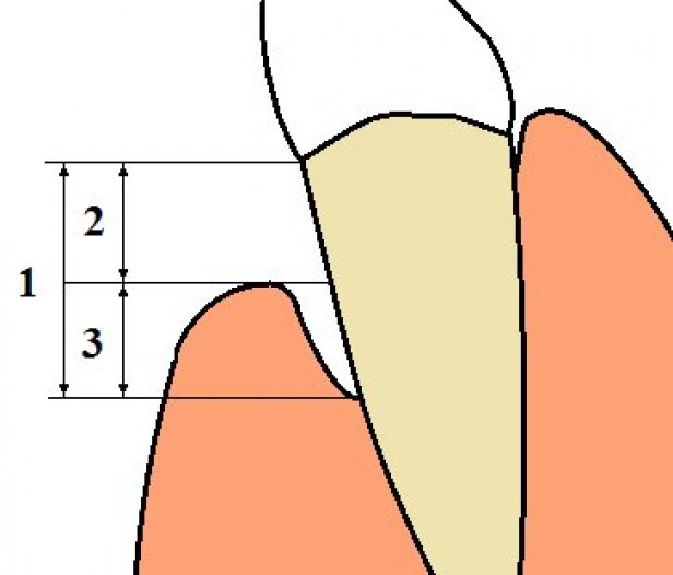 Quels sont les différents types de parodontites ?