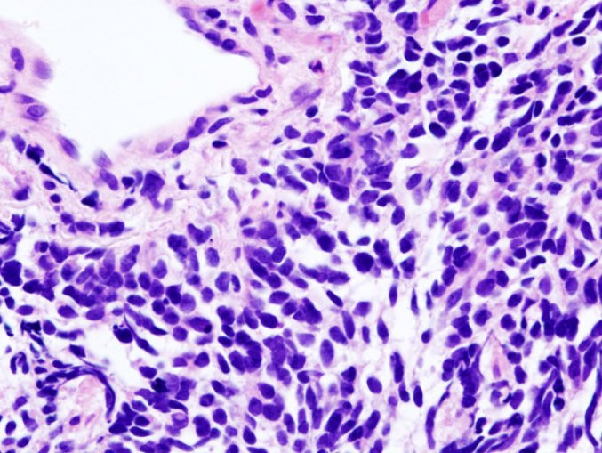 Illustration : carcinome du poumon à petites cellules vu au microscope 