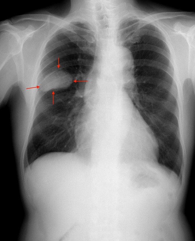 Photo : cancer bronchique à petites cellules (à droite) par radiographie