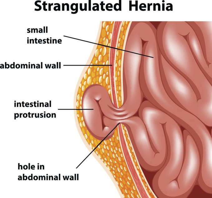 Quelles sont les complications de la hernie crurale ?