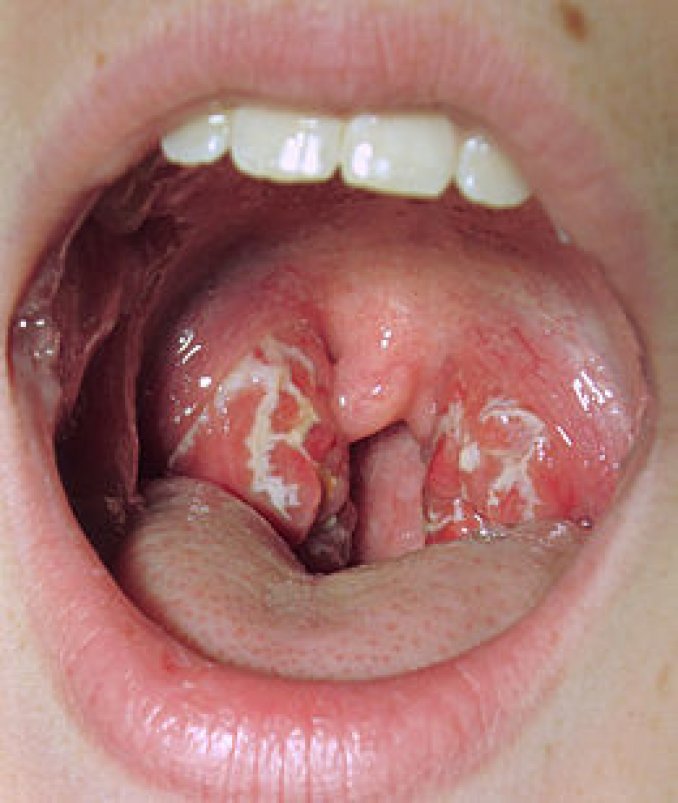 Photo : angine érythémato-pultacée potentiellement due à un streptocoque bêta-hémolytique du groupe A