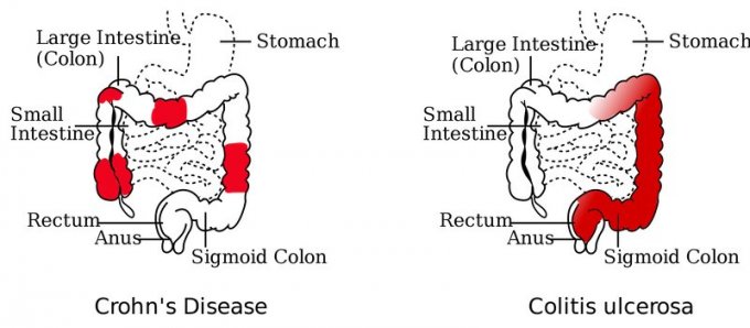 Quelles zones sont touchées par la maladie de Crohn ?