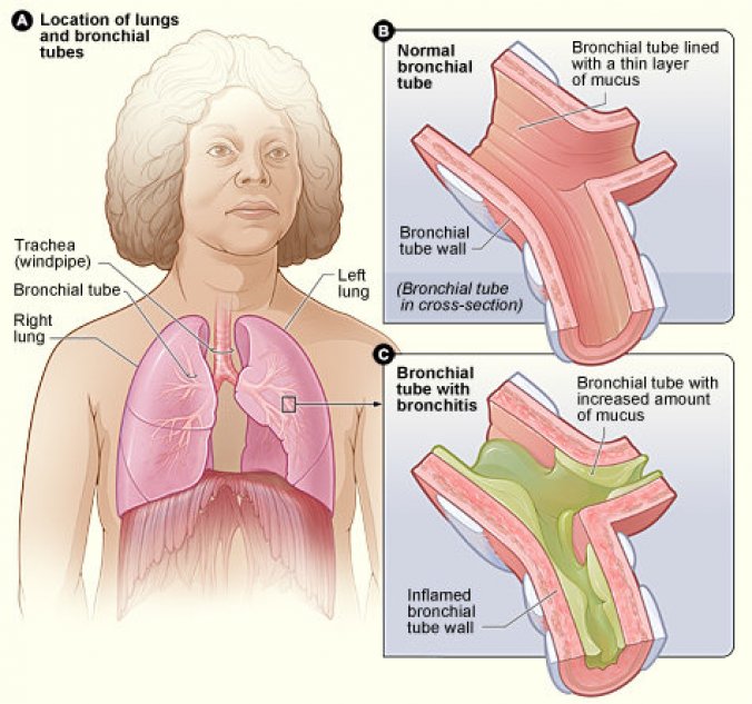 Schéma : comparaison des bronches en situation normale (en haut) et en cas de bronchite aiguë (en bas) démontrant l&apos;inflammation de la paroi et l&apos;augmentation de la production de mucus.