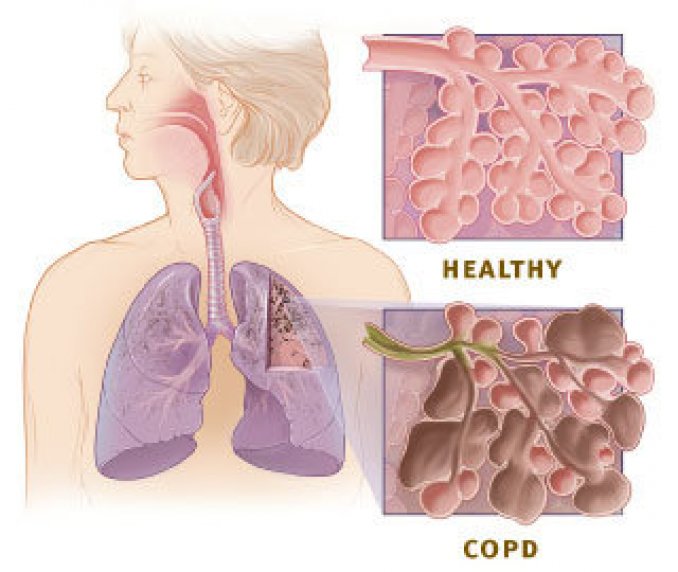 Schéma : différence entre un poumon sain et un poumon atteint de BPCO (en bas)