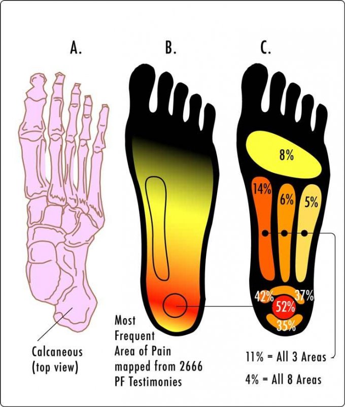 Aponévrosite plantaire (fasciite plantaire) : quels traitements pour soulager la douleur au pied ?