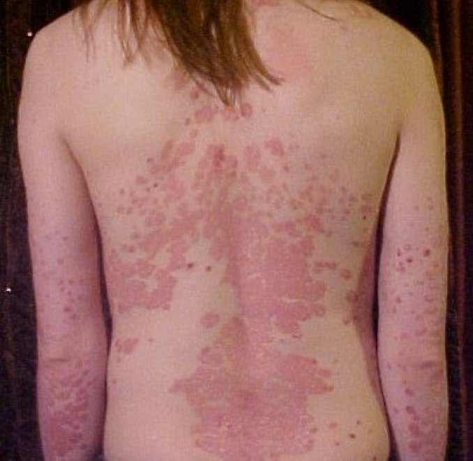 Photo : psoriasis en plaques dans le dos