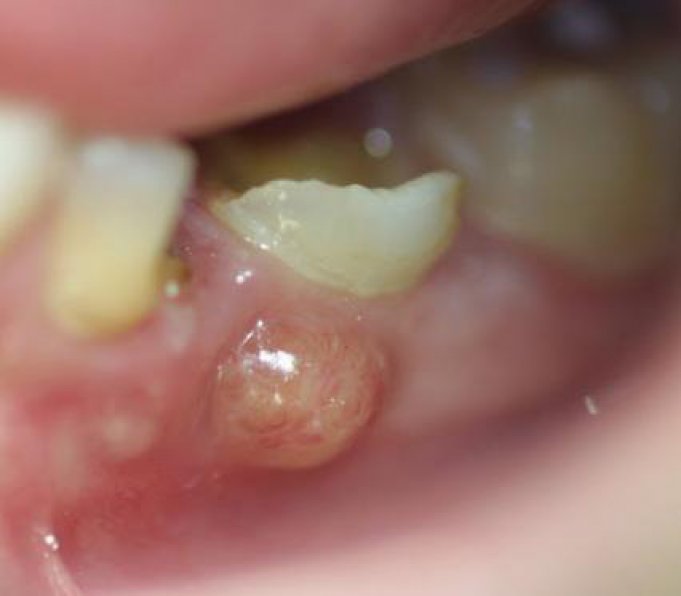 Qu’est-ce qu’un abcès dentaire ?