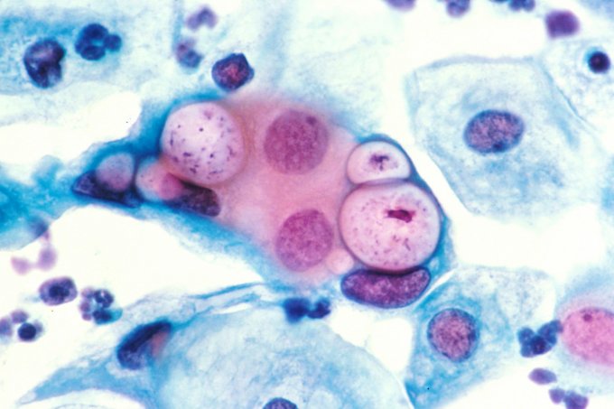 Chlamydia : quelles sont les personnes les plus couramment infectées par cette bactérie ?