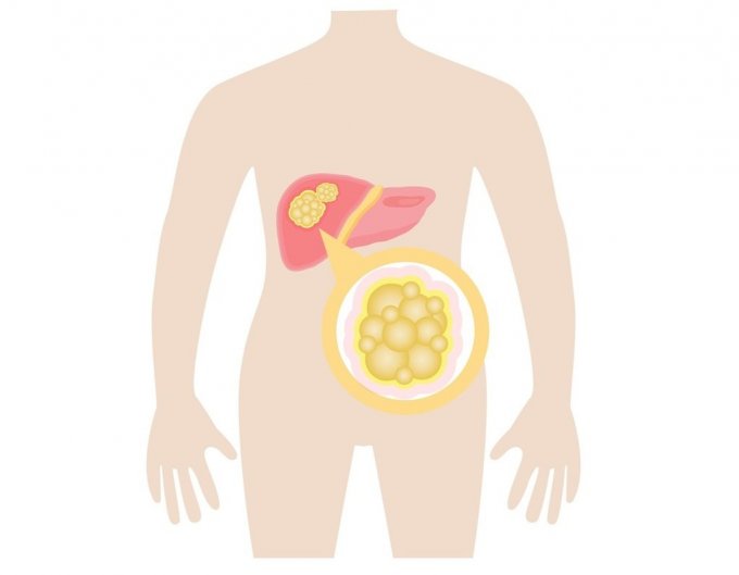 Différents types de cancers du foie : primitifs, secondaires et rares