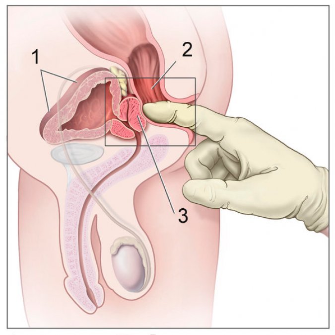 quels sont les premiers symptômes du cancer de la prostate