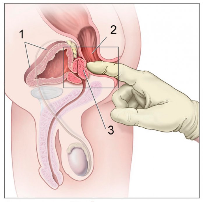 symptômes cancer prostate prosztata anatómia
