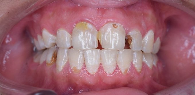 Rage de dents : quels sont les facteurs de risque ?