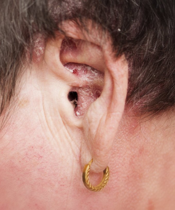 Définition : le psoriasis des oreilles, c&apos;est quoi ? Quels sont les symptômes ?